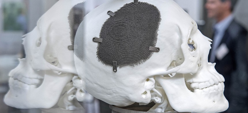 A 3D print of a fully porous titanium grade five cranial implant for a patient.