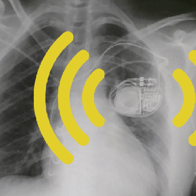 My Pacemaker Is Tracking Me From Inside My Body - Nextgov/FCW