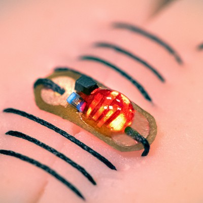 'Smart Sutures' Monitor Deep Wounds to Prevent Problems - Nextgov/FCW